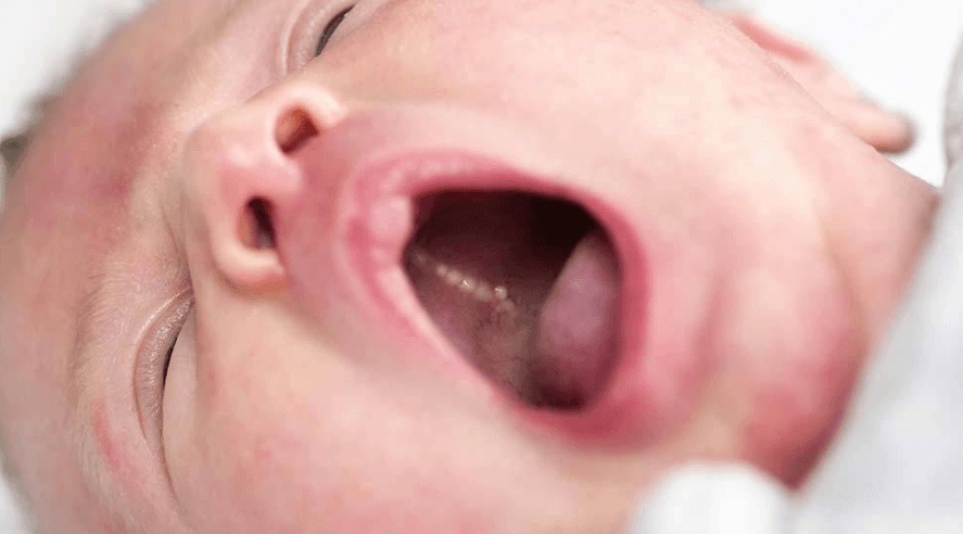 Ke parë pika të vogla të bardha në gojën e bebit? Ja ç'duhet të dish